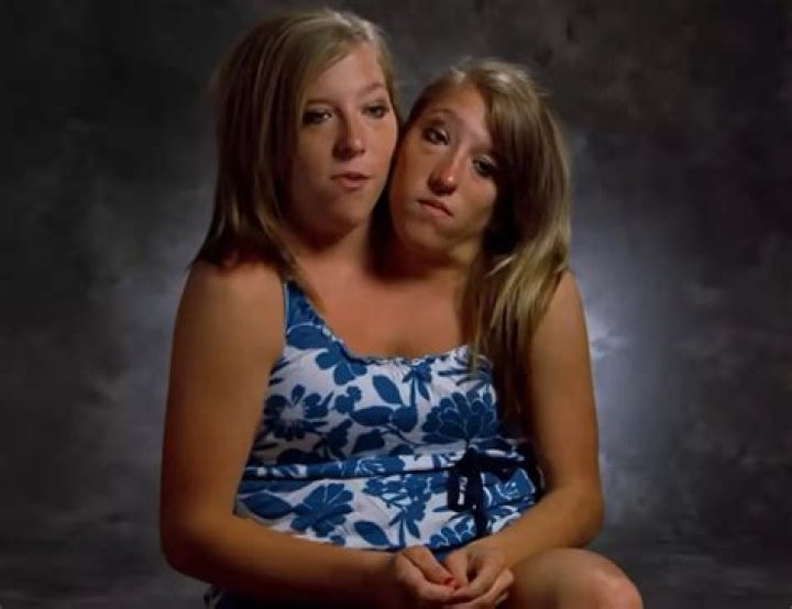 Australian Conjoined Twin Girls Die