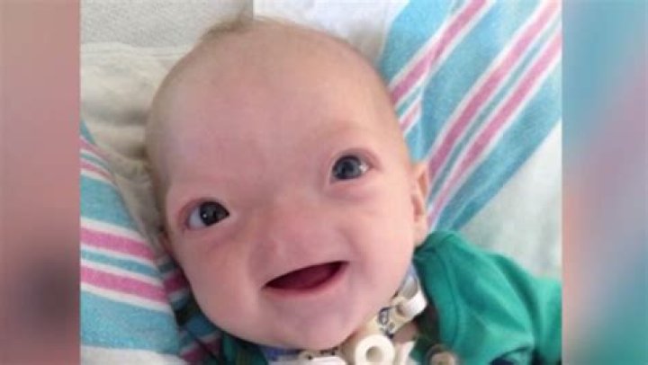 Baby Born Without Nose