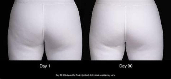 Best Cellulite Treatment For Butt & Thighs – Expert Tips – Hollywood Life