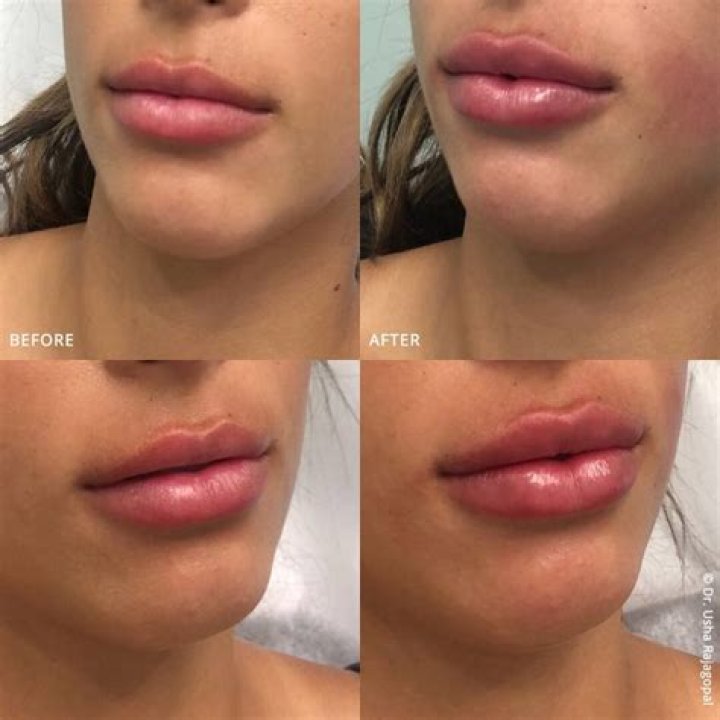 Brielle Biermann Reinjects Lip Fillers 1 Month After Dissolving Them – ‘I Couldn’t Be Happier’