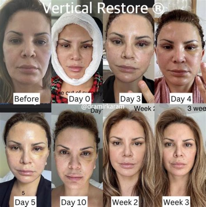 Christy Mack Recovery Facial Reconstruction