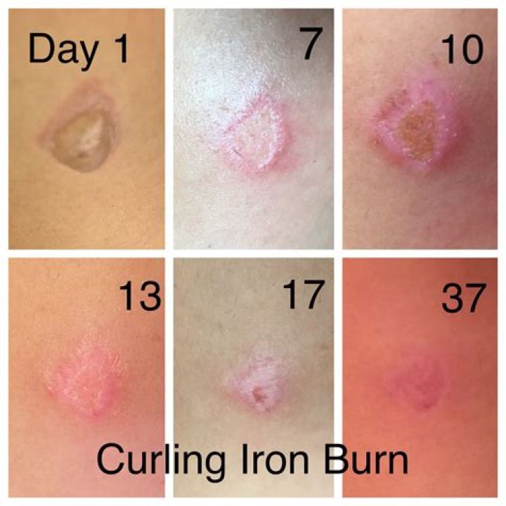 Curling Iron Burn