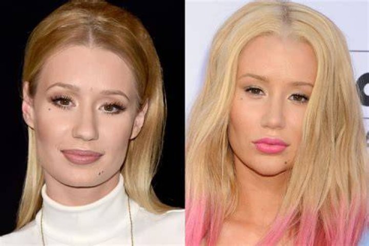 Did Iggy Azalea Have More Plastic Surgery & Fillers? Experts Think So – Hollywood Life