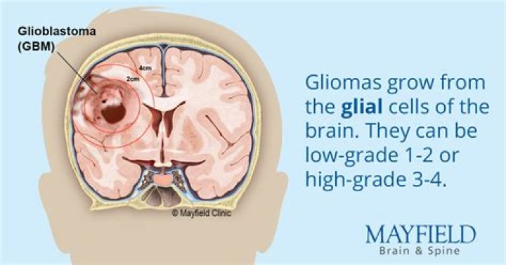 Glioblastoma: 5 Things To Know About The Brain Cancer John McCain Was Diagnosed With