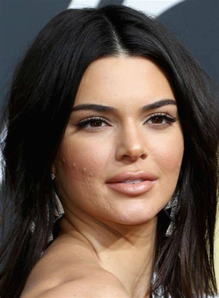 Kendall Jenner Acne
