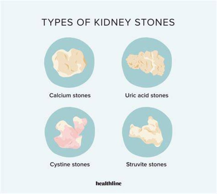 Kidney Stones: 5 Things To Know About Ailment That Sent Liam Hemsworth To The Hospital