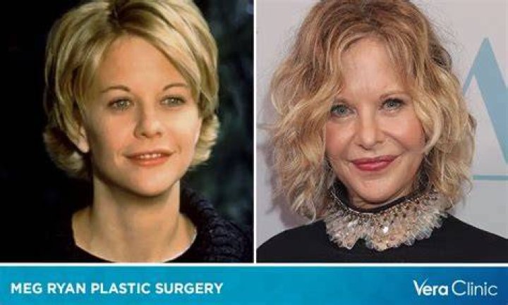 Meg Ryan Plastic Surgery