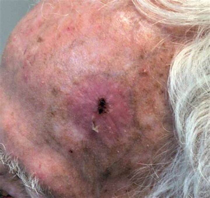Nurse, 29, Posts Selfie Of Blistered Face To Show Dangers Of Skin Cancer Inspires Others