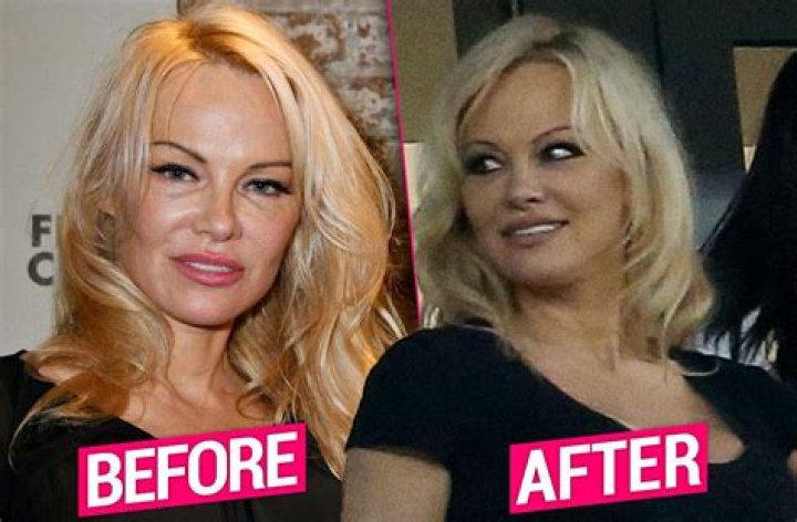 Pamela Anderson Plastic Surgery