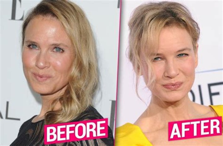 renee zellweger before after