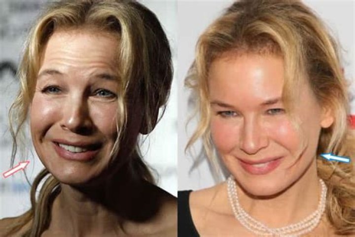 Renee Zellweger Plastic Surgery Interview