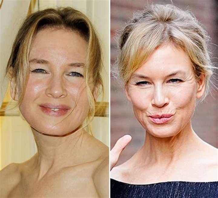 Renee Zellweger Speaks Out About Her Plastic Surgery In New Interview