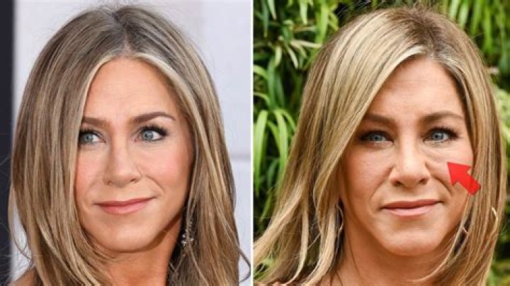 ‘RHOC’s Emily Simpson Gets Fillers Dissolved — Before & After Photos – Hollywood Life