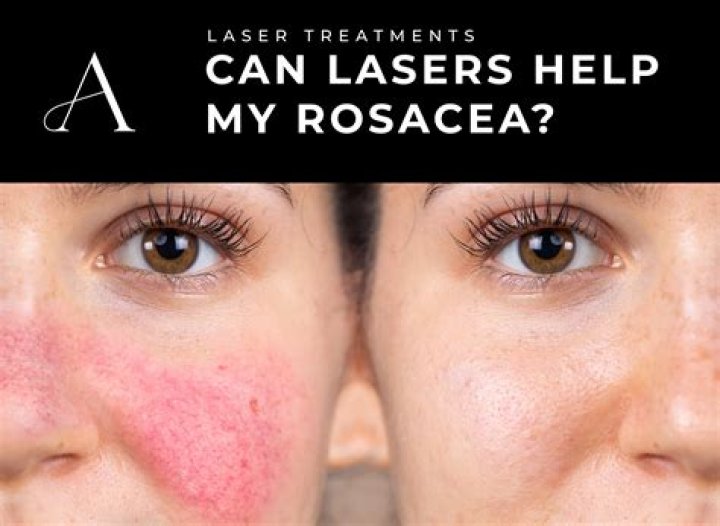 Rosacea — Are You A Victim: The 4 Treatment Tips You Need To Know