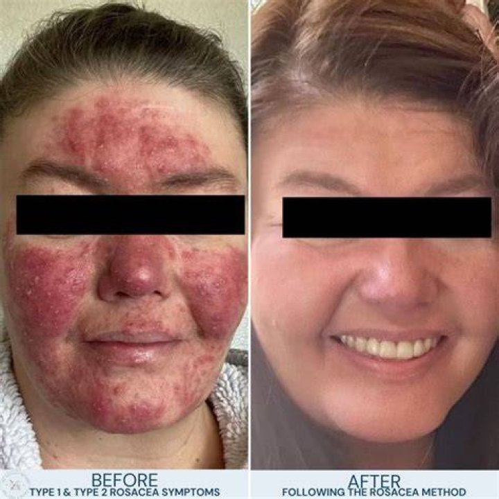 rosacea cures treatments