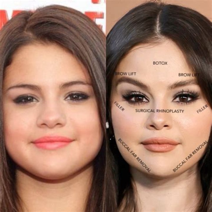Selena Gomez Talks Kidney Surgery & The Life-Threatening Complications: I Knew I Could ‘Actually Die’