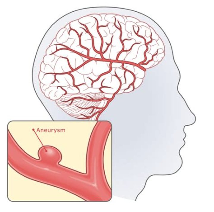 Tommy Ford Cause Of Aneurysm