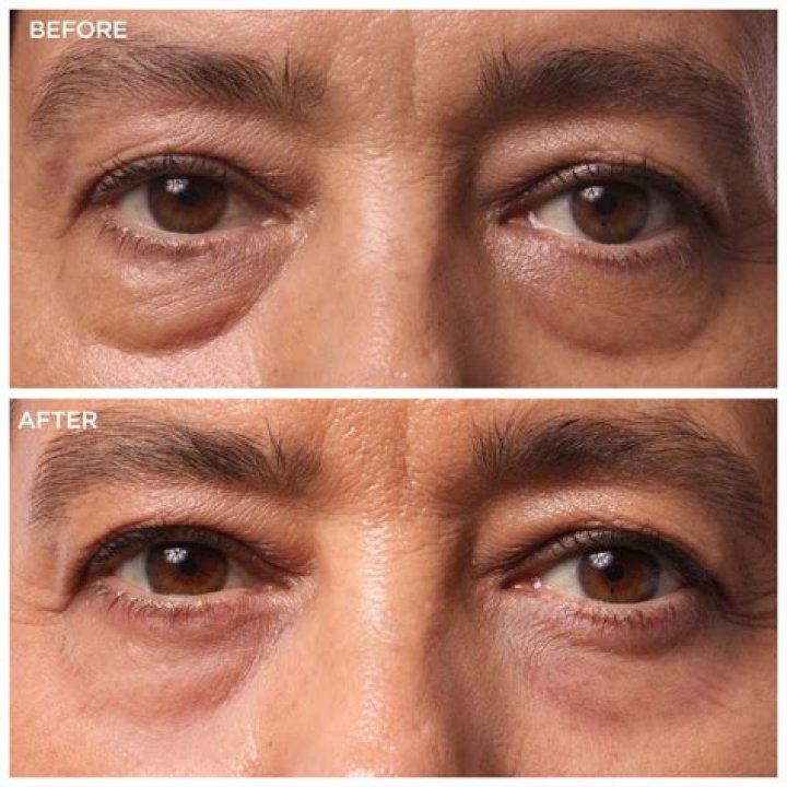 Under Eye Bag Removal — Her Tips – Hollywood Life