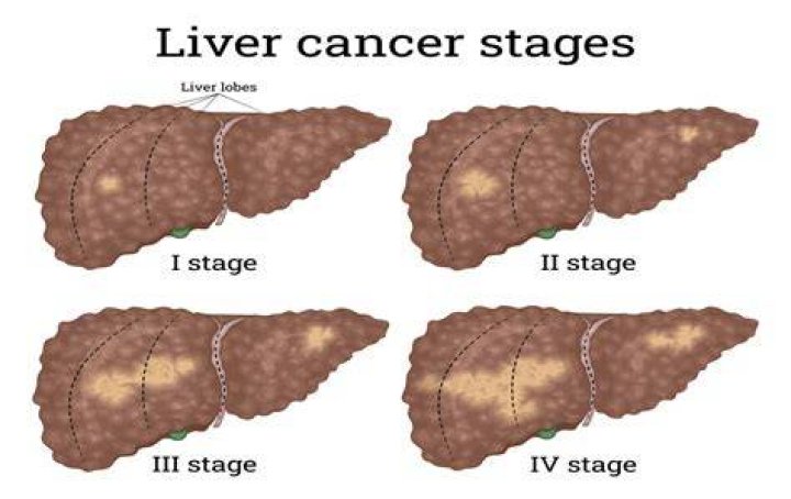 What Is Liver Cancer