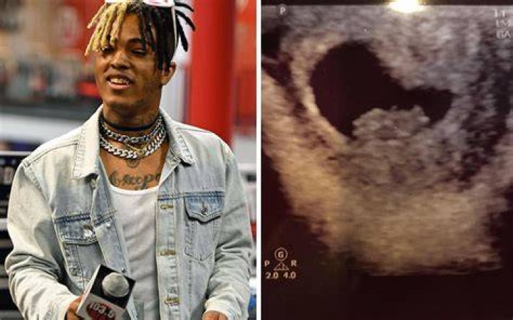 xxxtentacion baby ultrasound